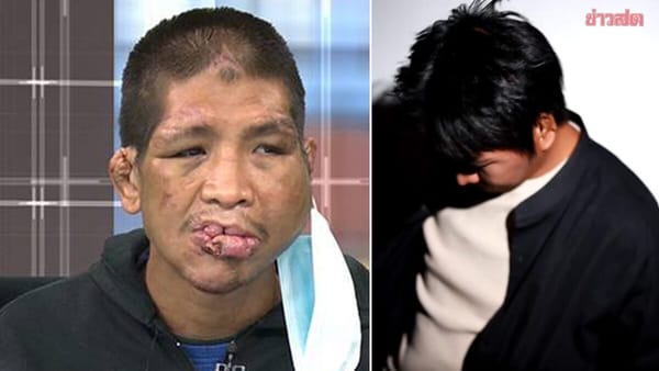 "น้องฟ้าโหนกระแส" พลิกชีวิตสู่โฉมใหม่: จากเหยื่อทารุณ สู่ความหวังครั้งใหม่หลังศัลยกรรม 4 ปี